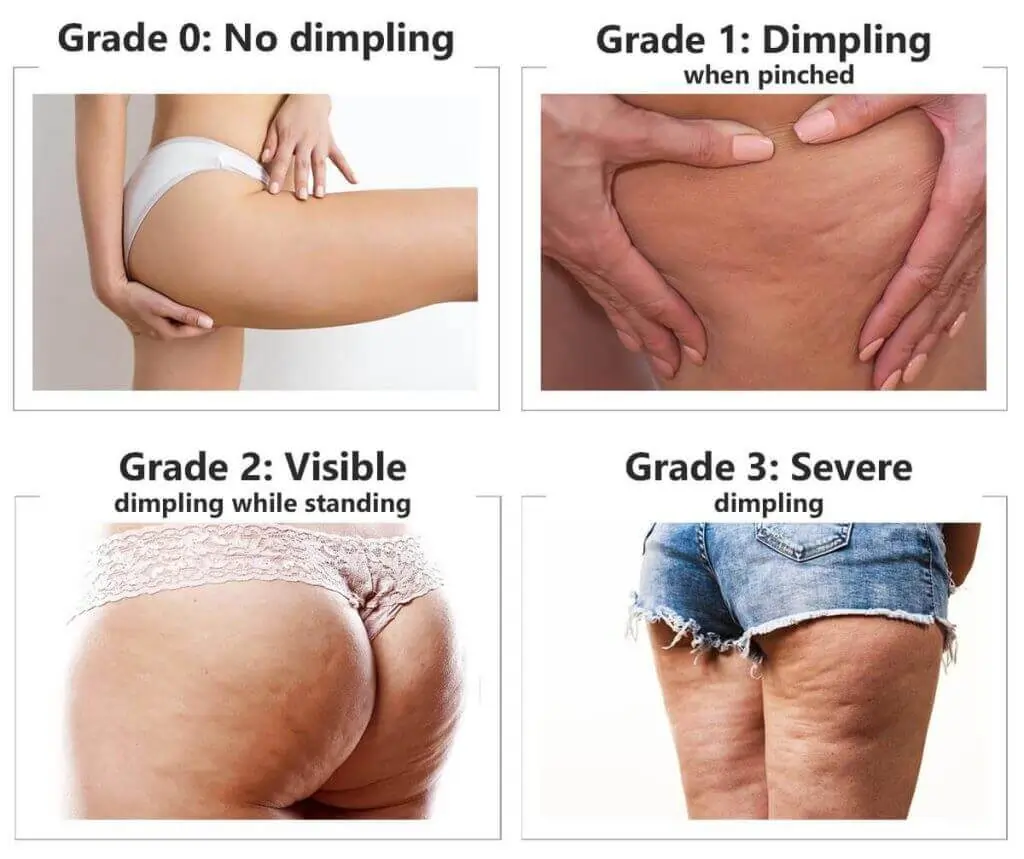 Representation of the stages of cellulite development Westbury